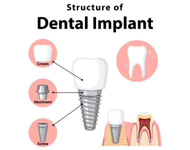 Dental Implants Brownsburg IN